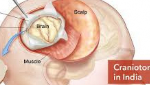 تكلفة علاج الصرع في الهند